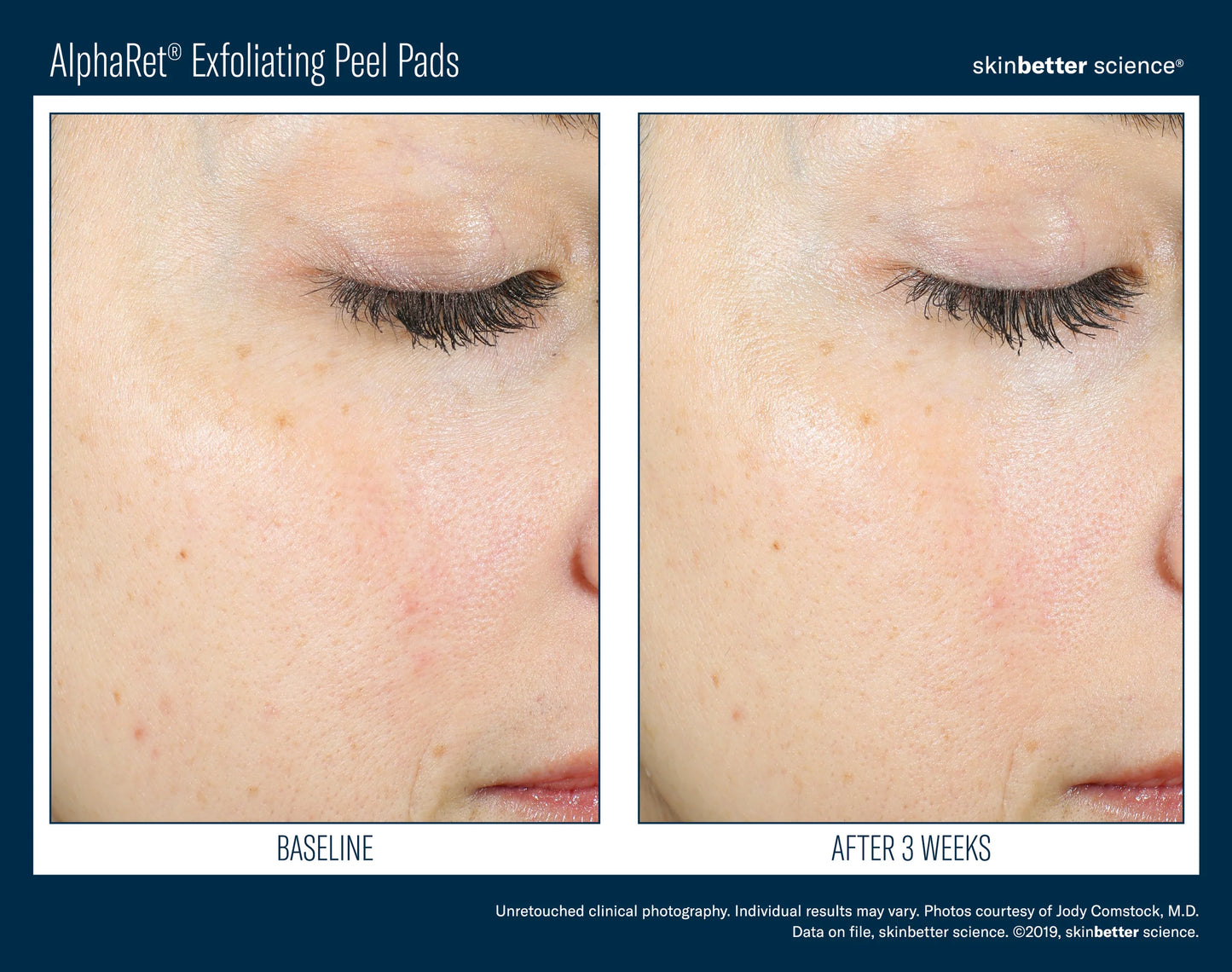 Alpharet exfoliating peel pads